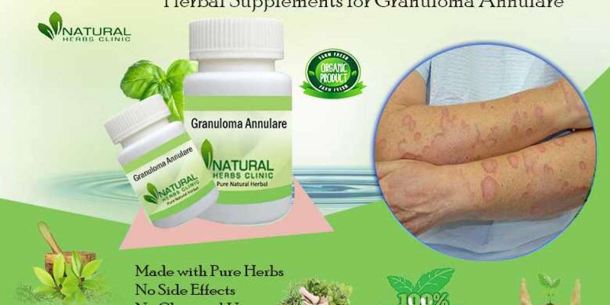 Effective Ways to Treat Granuloma Annulare: What You Should Know