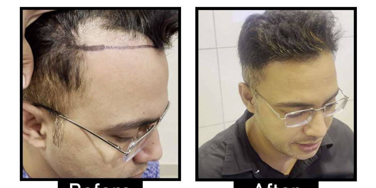 Affordable and Effective Hair Transplant in Delhi NCR